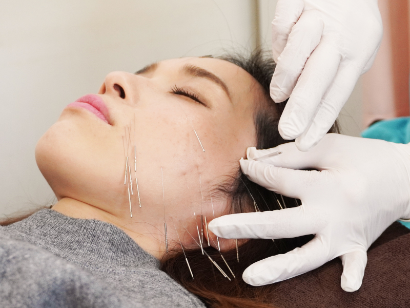 美容鍼灸の画像